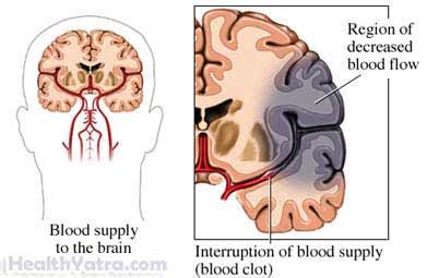 Apraxia Definition, Causes, Symptoms, Complications and Cost Surgery Treatment Hospital in India