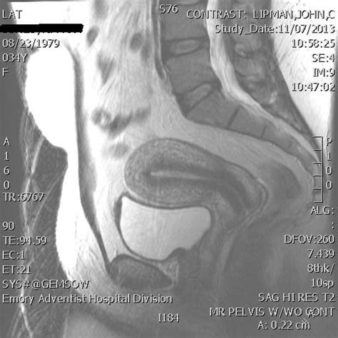 Pelvic MRI for Fibroids & Adenomyosis - Real MRI Images