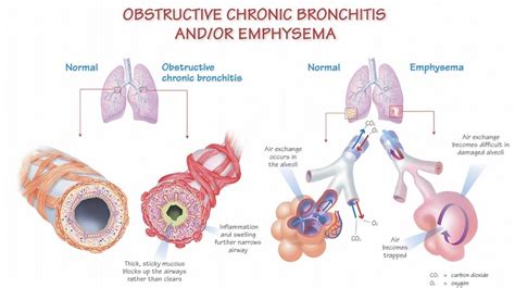 Managing COPD flare-ups - Hamilton Health Sciences