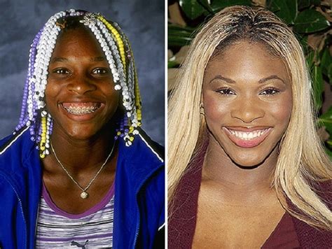 Serena Williams Before and After Plastic Surgery