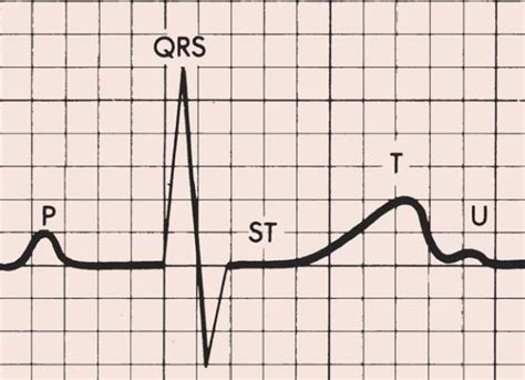 ECG T wave changes and interpretation