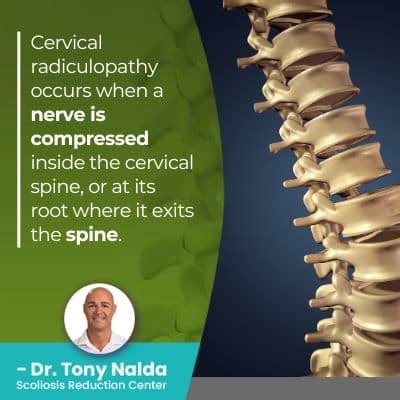 What Is Cervical Radiculopathy? Symptoms And Treatments