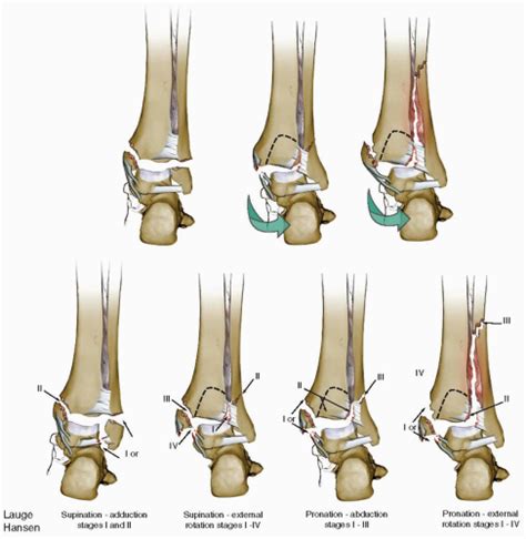 Ankle Fractures | Musculoskeletal Key