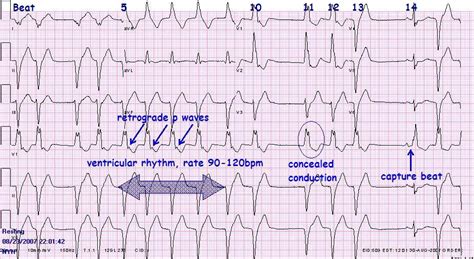 Accelerated Idioventricular Rhythm