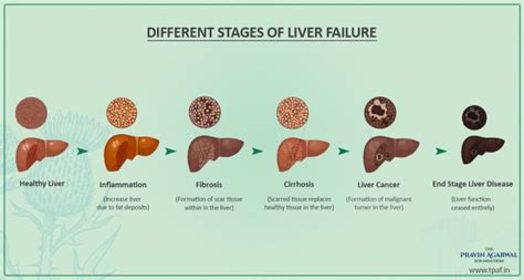 What Are The Different Stages Of Liver Failure?