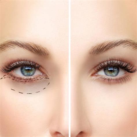 Lumi Eyes - Skin Lab Beauty Clinic