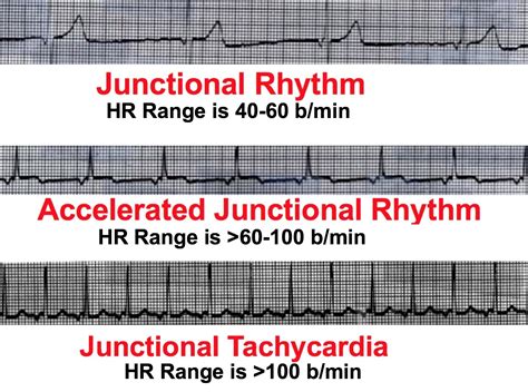 Junctional Rhythms