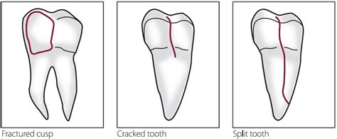 Cracked Tooth