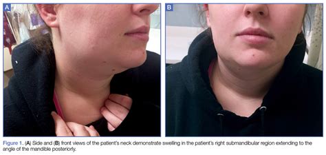 Acute Submandibular Sialadenitis | MDedge Emergency Medicine