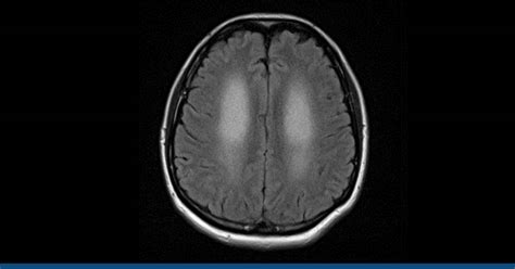 Hashimoto's Encephalopathy (He): Diagnosis, Symptoms, And More