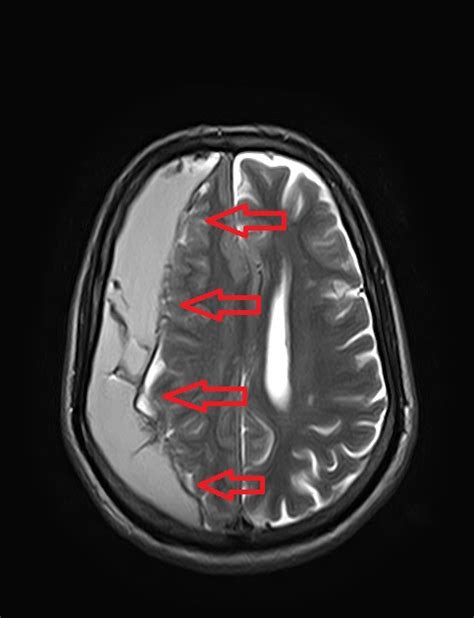 Subdural hematoma MRI - wikidoc