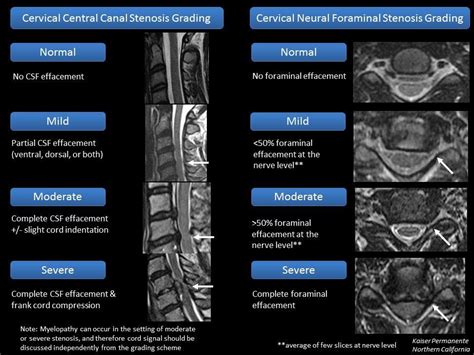 Cervical Central Canal and Neural Foraminal Stenosis ... | Stenosis, Diagnostic imaging ...