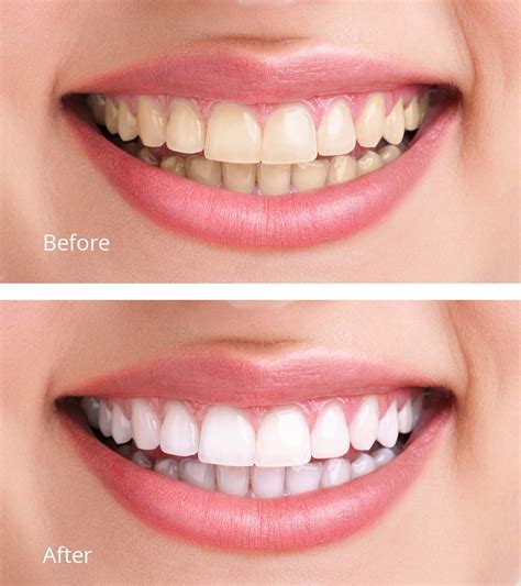 Teeth Whitening Services in Fort Worth - H. Peter Ku, D.D.S., P.A.