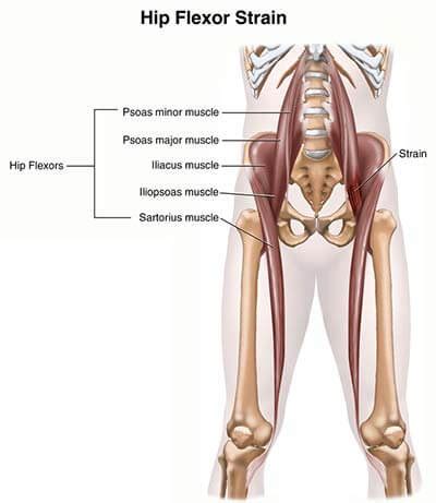 Hip Flexor Strain Treatment Doctors (Hip Pain Specialists) Brooklyn NY