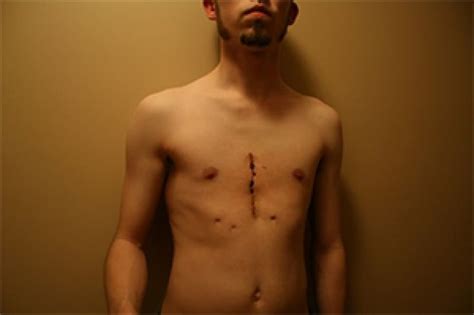 23 best Pectus Excavatum images on Pinterest | Surgery, Exercise and ...