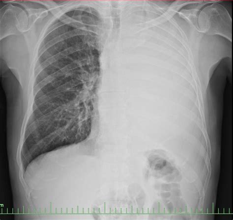 Lung cancer x ray - wikidoc