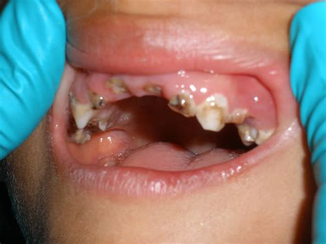 How Junk Food and Sodas Ruin Kids' Teeth in Developing Countries - The ...