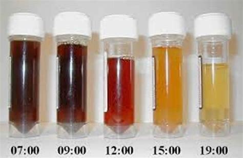 Paroxysmal nocturnal hemoglobinuria causes, symptoms, diagnosis, treatment & prognosis