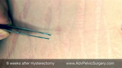 Scar after hysterectomy - YouTube