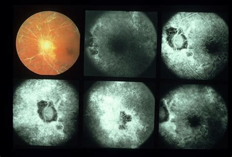 Eales Disease - Retina Image Bank