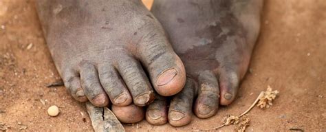 Guinea-Worm Disease (Dracunculiasis) | WHO | Regional Office for Africa