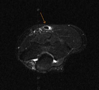 Biceps Tendon Tear-MRI - Sumer's Radiology Blog