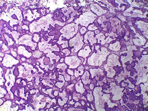 Plexiform Ameloblastoma Histology