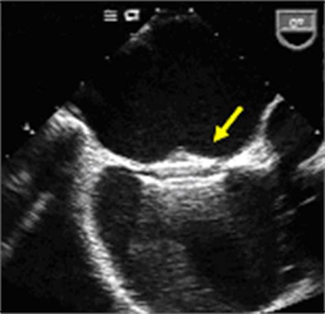 Patent Foramen Ovale (PFO) closure