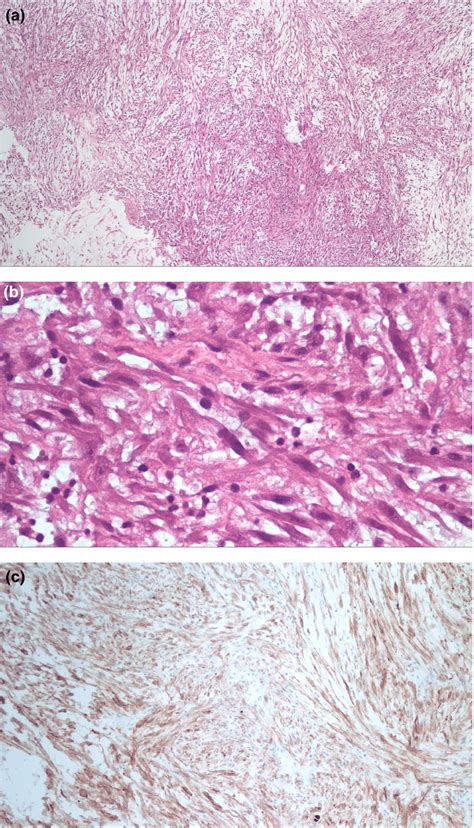 A and B, Histological examination. Tumor showing stellate cells in a ...