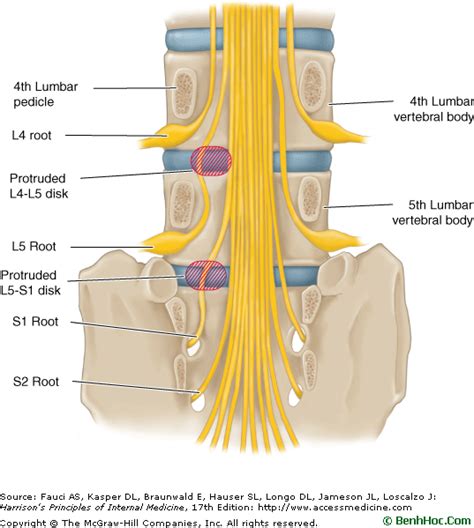 L5 S1 Nerve Root Compression. | Back off pain | Pinterest | Sciatica pain relief, Sciatica and ...