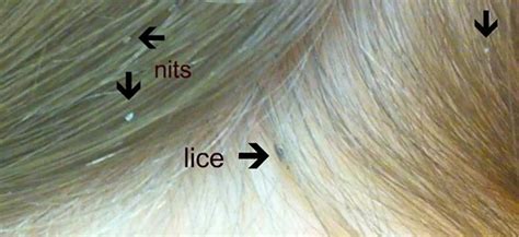 How to check for Lice and How to get rid of it.