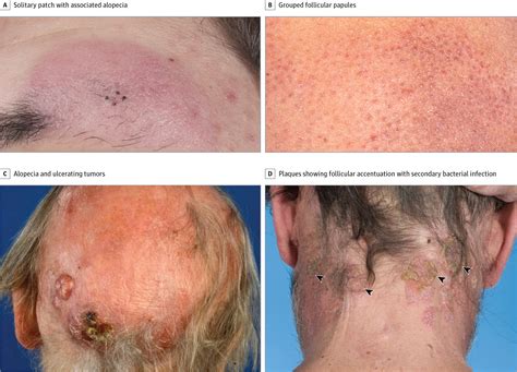 Staging, Prognostic Factors, and Folliculotropic Mycosis Fungoides | Allergy and Clinical ...