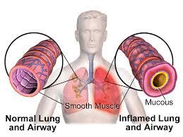 Bronchospasm: Causes, Picture, Symptoms, And Treatment