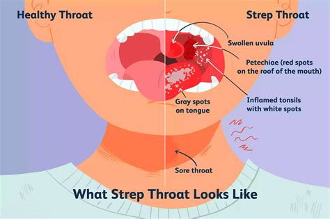 Les Streptocoques tests — FlexMedic