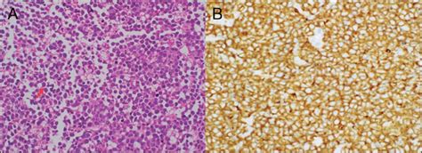 (A) Omental biopsy showing atypical lymphoid cells with enlarged... | Download Scientific Diagram