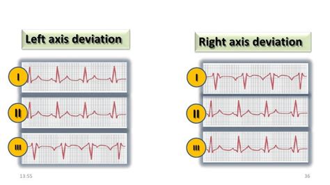 Ecg reading