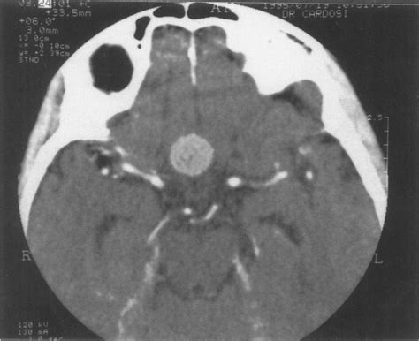 Enhanced CT scan showing a small tuberculum sellae meningioma ...