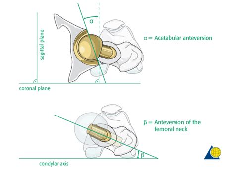 Ensure correct rotational alignment (normal anteversion) of both ...