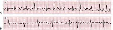 Atrial Fib Vs Flutter