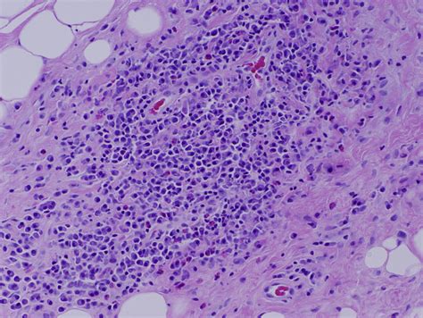 IgG4-related disease manifesting as sclerosing orbital inflammation and cutaneous pseudolymphoma ...