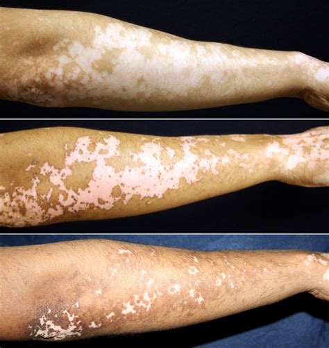 Vitiligo Treatment Holds Promise for Restoring Skin Pigmentation