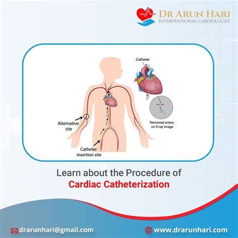 Learn about the procedure of cardiac catheterization – Artofit