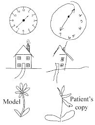 Image result for hemineglect syndrome