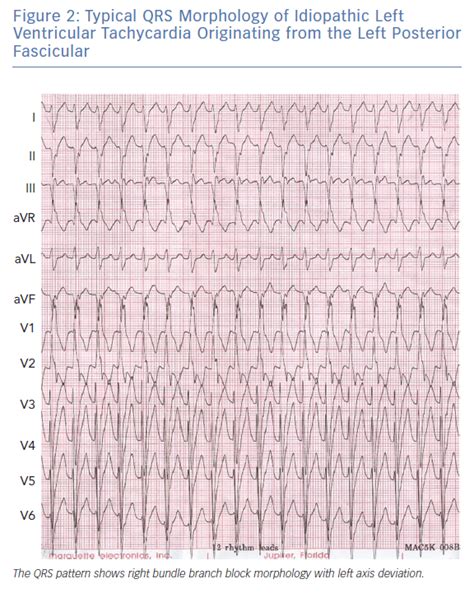 Idiopathic Left Ventricular Tachycardia Originating in the Left Posterior Fascicle | AER Journal