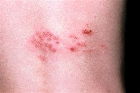 Painful Shingles Can Strike More Than Once - WSJ