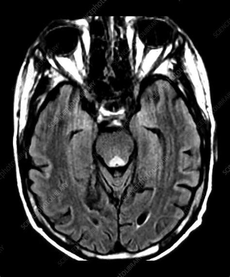 Wernicke's Encephalopathy on MRI - Stock Image - C043/0260 - Science ...