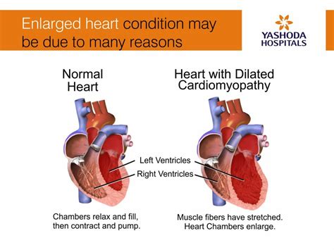 Enlarged Heart: What are its causes?