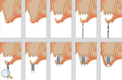 "Sinus Lift" Procedure - The Return of Intra-Oral Sinus Surgery | Fauquier ENT Blog