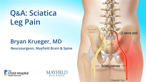 Q&A: Sciatica leg pain w/ Dr. Bryan Krueger