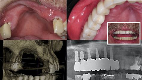 Solutions for Patients with Severe Bone Loss Who Want Dental Implants ...